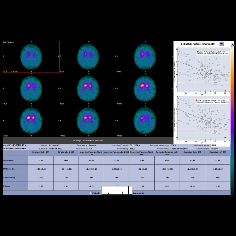 DATScanSzintigraphie Radiologie und Nuklearmedizin Ludwigshafen