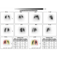 Lungenszintigraphie | Radiologie und Nuklearmedizin Ludwigshafen