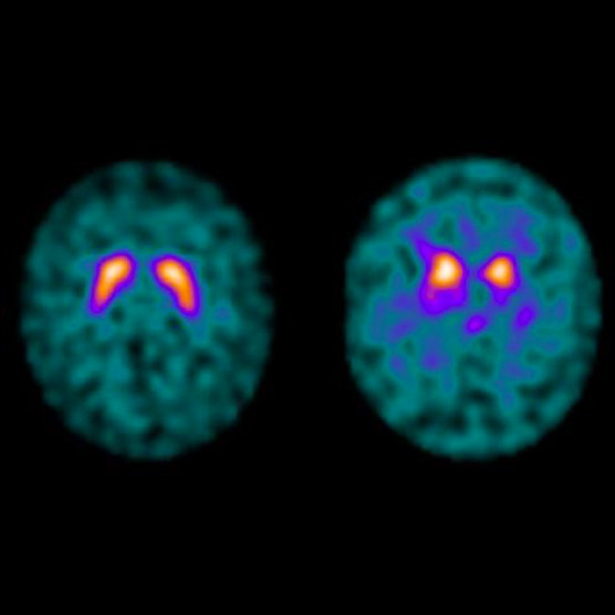 DATScanSzintigraphie Radiologie und Nuklearmedizin Ludwigshafen